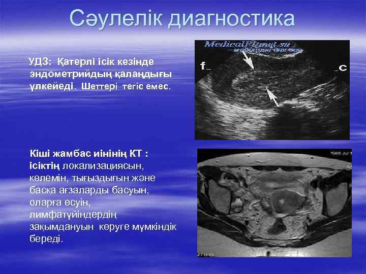Сәулелік диагностика УДЗ: Қатерлі ісік кезінде эндометрийдың қалаңдығы үлкейеді. Шеттері тегіс емес. Кіші жамбас