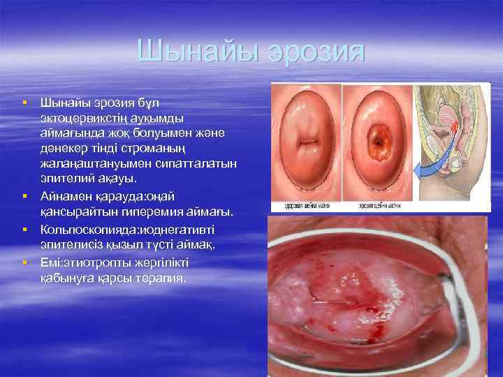 Шынайы эрозия § Шынайы эрозия бұл эктоцервикстің ауқымды аймағында жоқ болуымен және дәнекер тінді