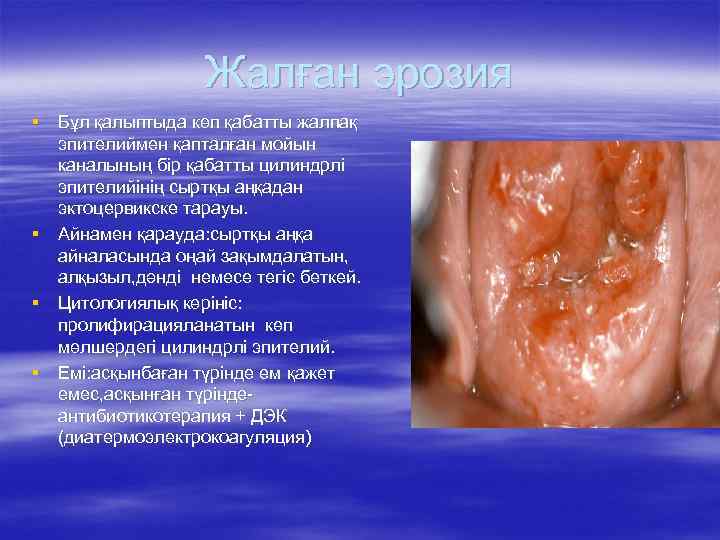 Жалған эрозия § Бұл қалыптыда көп қабатты жалпақ эпителиймен қапталған мойын каналының бір қабатты