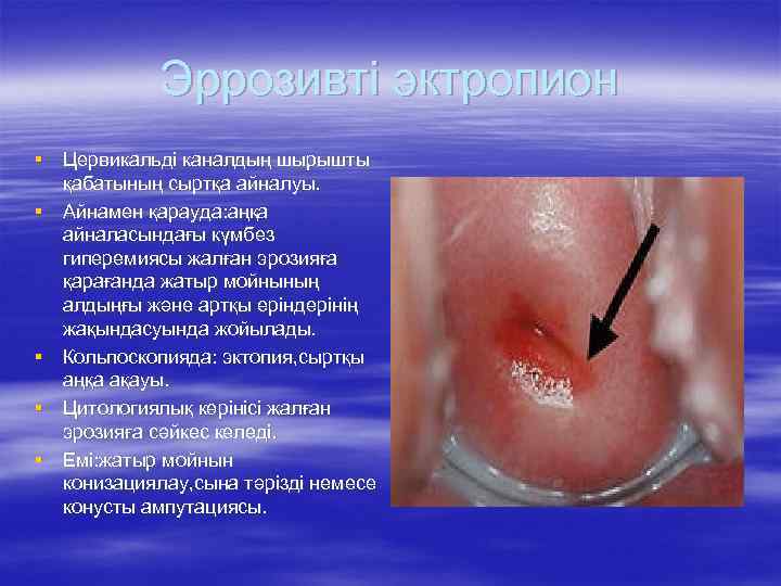 Эррозивті эктропион § Цервикальді каналдың шырышты қабатының сыртқа айналуы. § Айнамен қарауда: аңқа айналасындағы