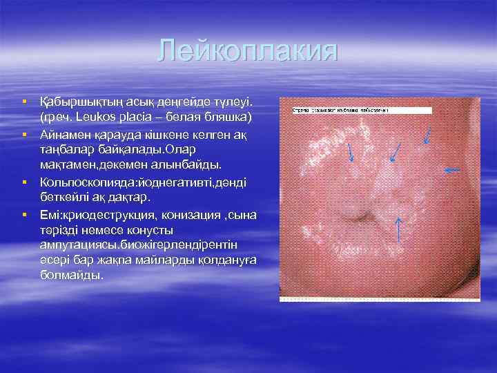 Лейкоплакия § Қабыршықтың асық деңгейде түлеуі. (греч. Leukos placia – белая бляшка) § Айнамен