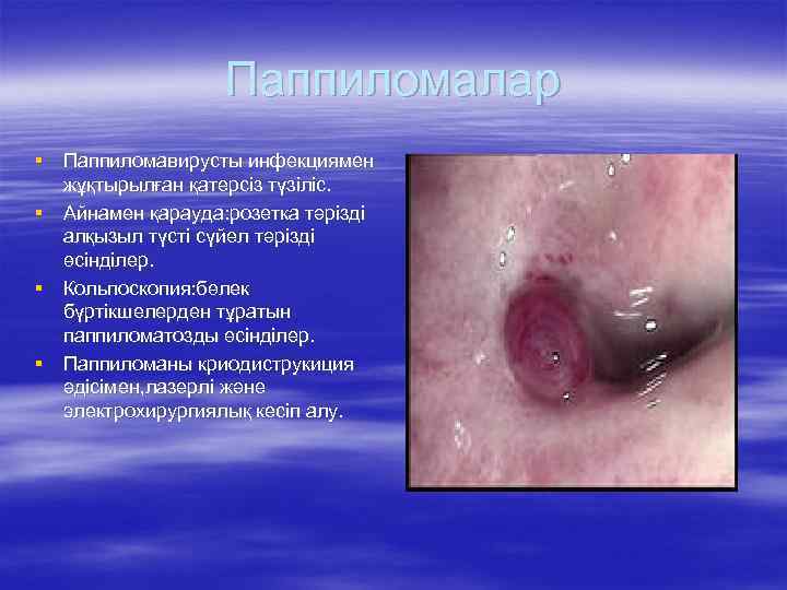 Паппиломалар § Паппиломавирусты инфекциямен жұқтырылған қатерсіз түзіліс. § Айнамен қарауда: розетка тәрізді алқызыл түсті