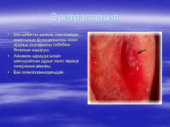 Эритроплакия § Көп қабатты жалпақ эпителийдің пластының функционалды және аралық атрофиясы себебіне болатын жұқаруы.