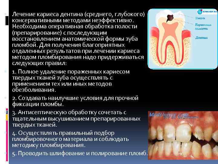  Лечение кариеса дентина (среднего, глубокого) консервативными методами неэффективно. Необходима оперативная обработка полости (препарирование)