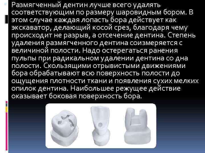  Размягченный дентин лучше всего удалять соответствующим по размеру шаровидным бором. В этом случае