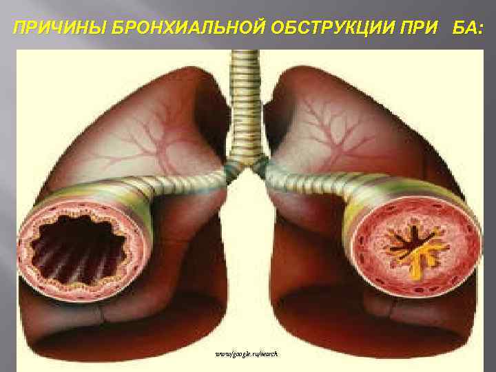 ПРИЧИНЫ БРОНХИАЛЬНОЙ ОБСТРУКЦИИ ПРИ БА: www/google. ru/search 