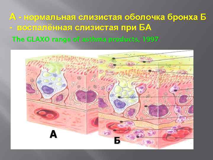 А - нормальная слизистая оболочка бронха Б - воспалённая слизистая при БА The GLAXO