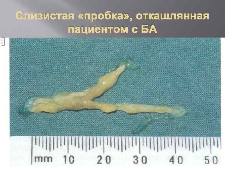 Слизистая «пробка» , откашлянная пациентом с БА 