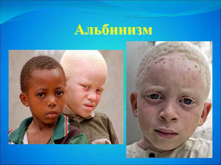 Альбинизм 