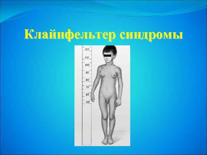 Клайнфельтер синдромы 
