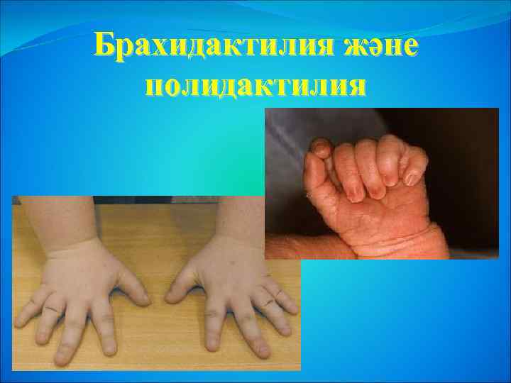 Брахидактилия және полидактилия 