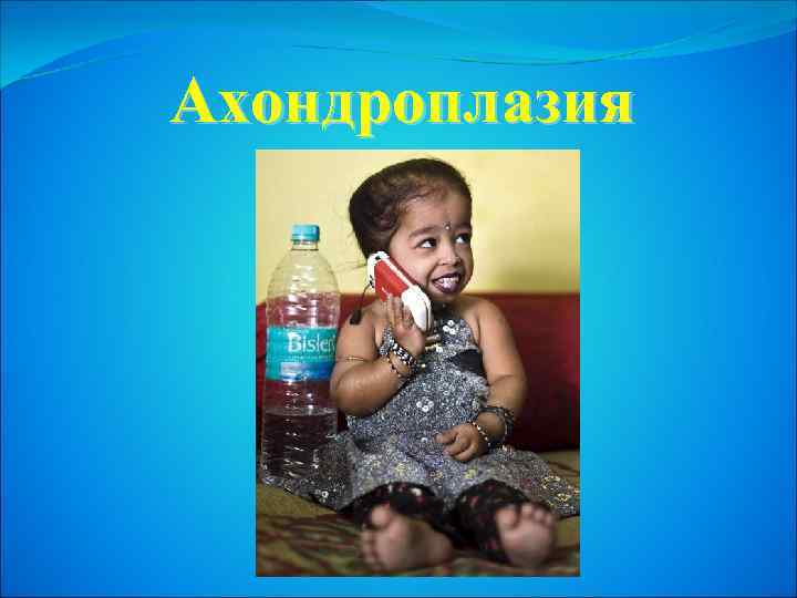 Ахондроплазия 