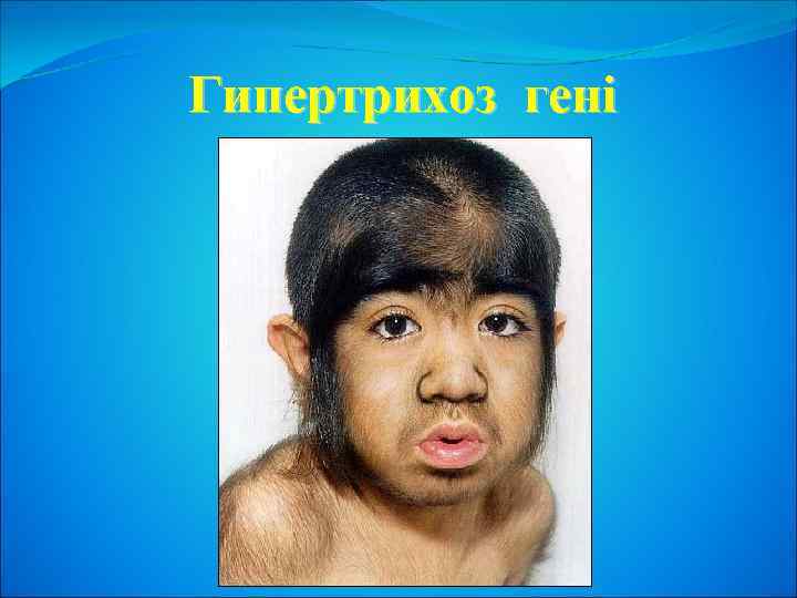 Гипертрихоз гені 