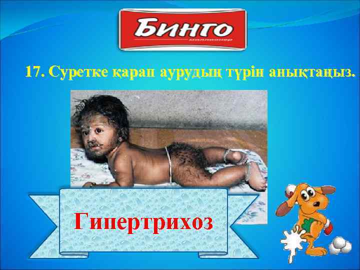 17. Суретке қарап аурудың түрін анықтаңыз. Гипертрихоз 