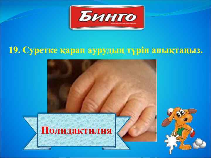 19. Суретке қарап аурудың түрін анықтаңыз. Полидактилия 