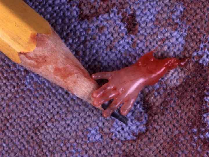 НАИБОЛЕЕ ВАЖНЫЙ ФАКТОР – МЕДИЦИНСКИЙ АБОРТ В АНАМНЕЗЕ! 