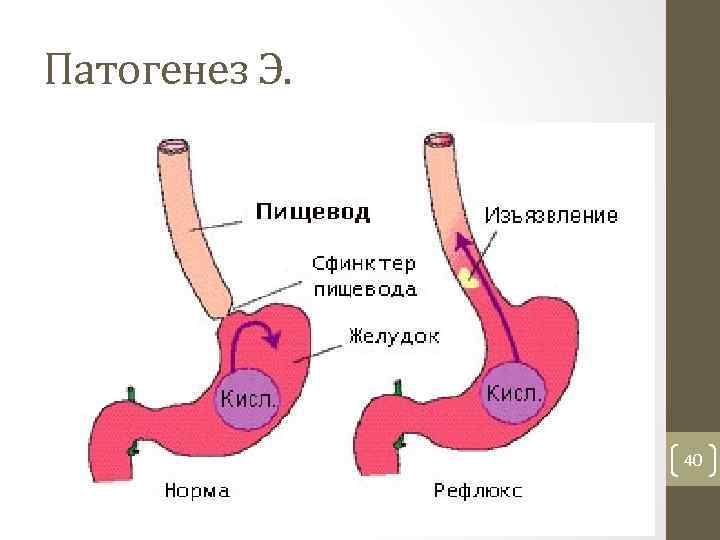 Патогенез Э. 40 