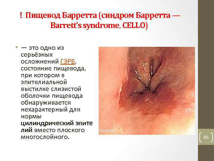 ! Пищевод Барретта (синдром Барретта — Barrett’s syndrome, CELLO) • — это одно из