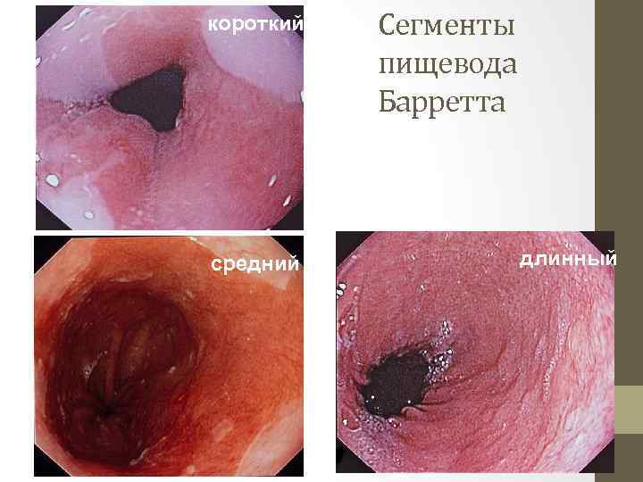 короткий средний Сегменты пищевода Барретта длинный 