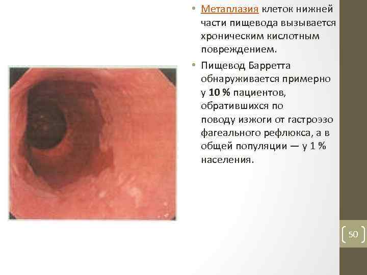  • Метаплазия клеток нижней части пищевода вызывается хроническим кислотным повреждением. • Пищевод Барретта