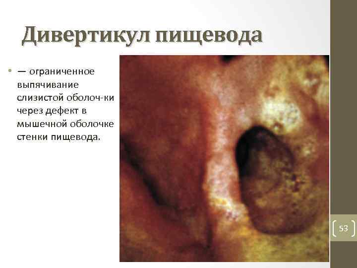 Дивертикул пищевода • — ограниченное выпячивание слизистой оболоч ки через дефект в мышечной оболочке