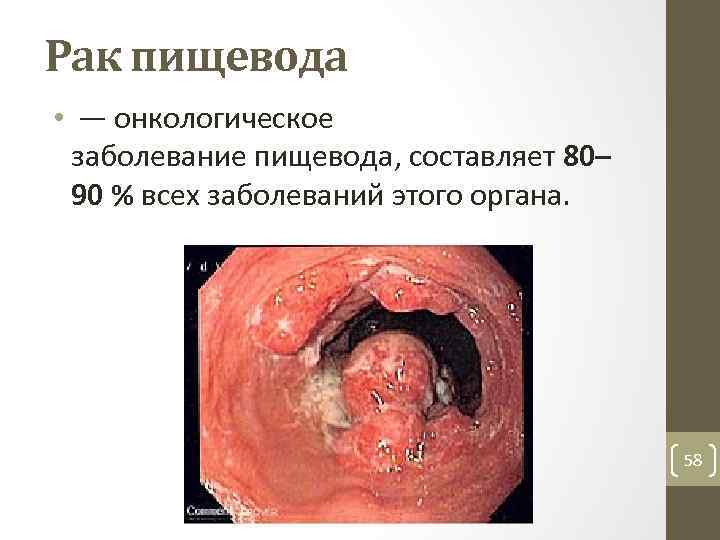 Рак пищевода • — онкологическое заболевание пищевода, составляет 80– 90 % всех заболеваний этого