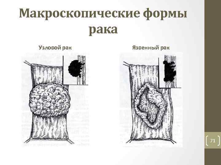 Макроскопические формы рака Узловой рак Язвенный рак 71 