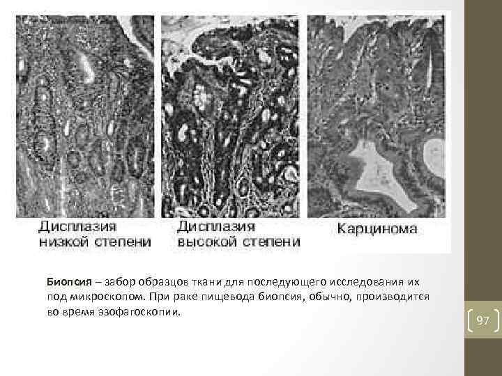 Биопсия – забор образцов ткани для последующего исследования их под микроскопом. При раке пищевода