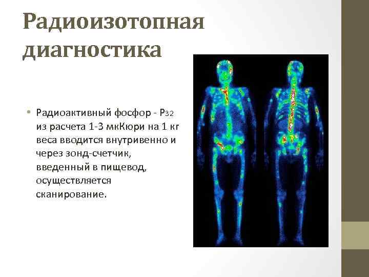 Радиоизотопная диагностика • Радиоактивный фосфор Р 32 из расчета 1 3 мк. Кюри на