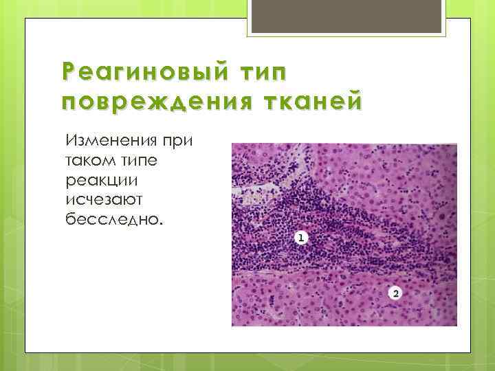 Реагиновый тип повреждения тканей Изменения при таком типе реакции исчезают бесследно. 