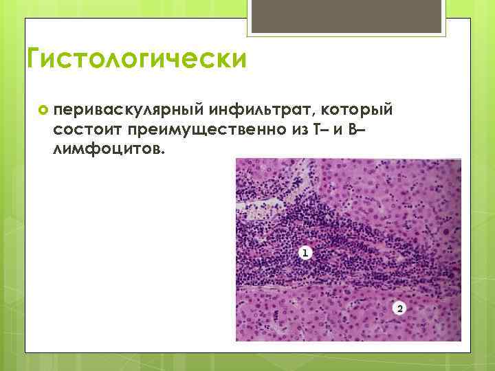 Гистологически периваскулярный инфильтрат, который состоит преимущественно из Т– и В– лимфоцитов. 