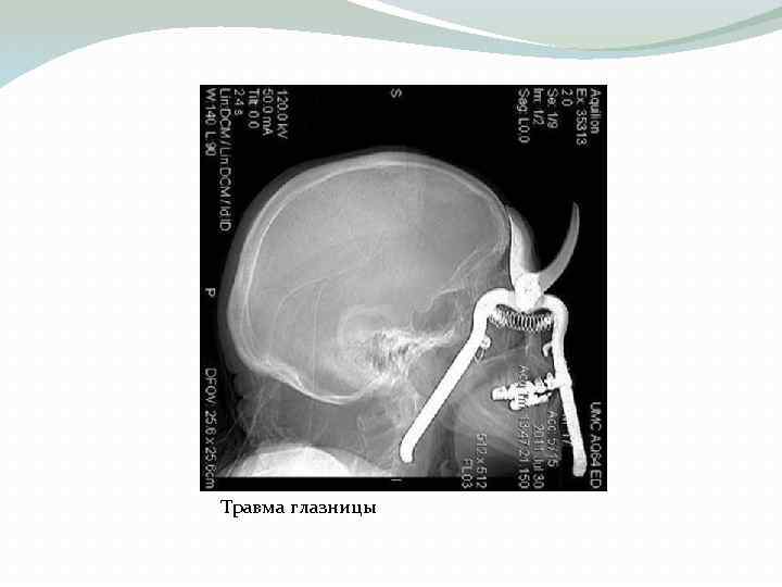 Травма глазницы 
