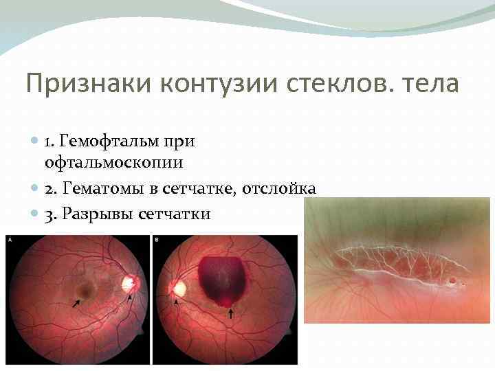 Признаки контузии стеклов. тела 1. Гемофтальм при офтальмоскопии 2. Гематомы в сетчатке, отслойка 3.