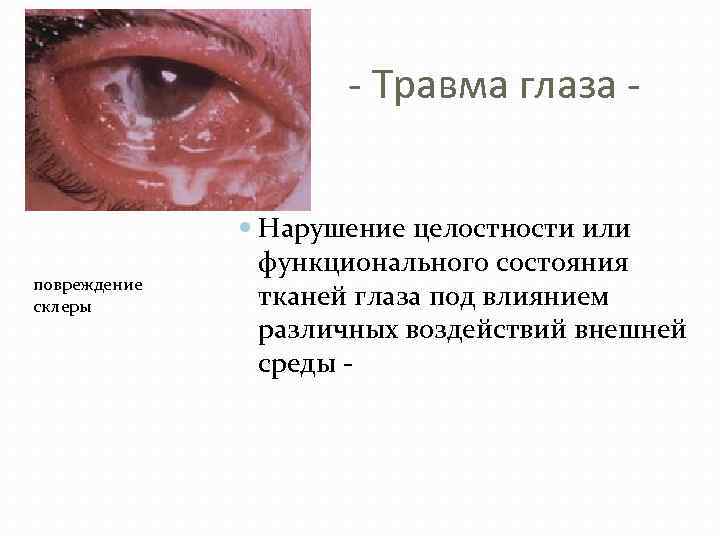 - Травма глаза - повреждение склеры Нарушение целостности или функционального состояния тканей глаза под