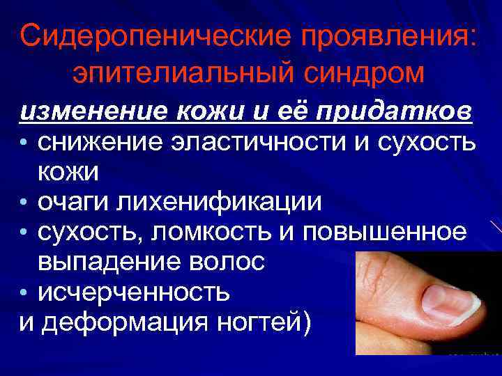Сидеропенические проявления: эпителиальный синдром изменение кожи и её придатков • снижение эластичности и сухость
