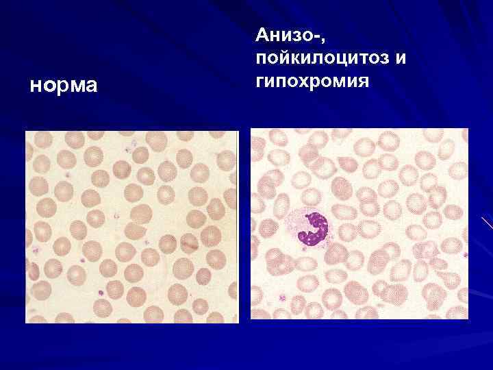 Пойкилоцитоз. Анизо и пойкилоцитоз. Анизоцитоз и пойкилоцитоз. Анизо и пойкилоцитоз при анемии. Пойкилоцитоз норма.