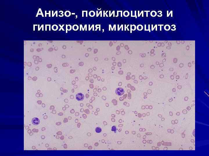 Анизо-, пойкилоцитоз и гипохромия, микроцитоз 