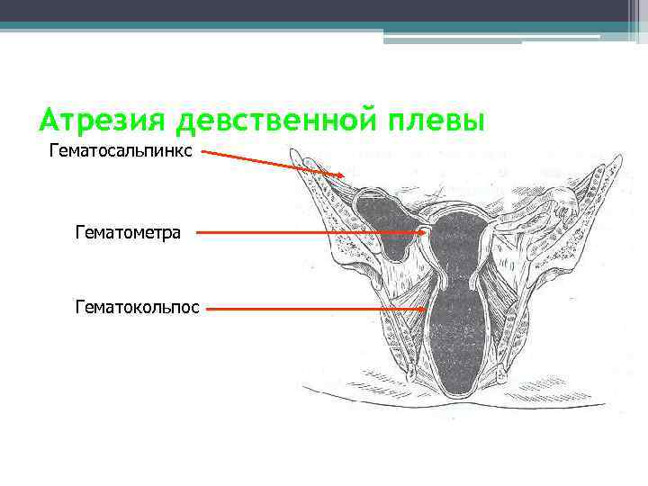 Атрезия девственной плевы Гематосальпинкс Гематомeтра Гематокольпос 