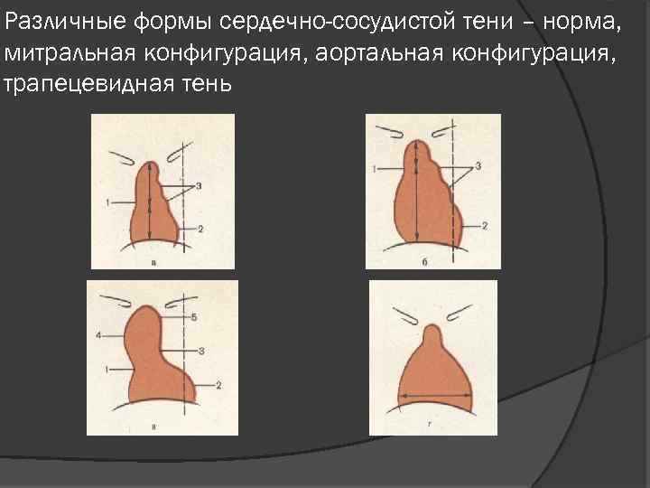 Нормальная конфигурация сердца рисунок