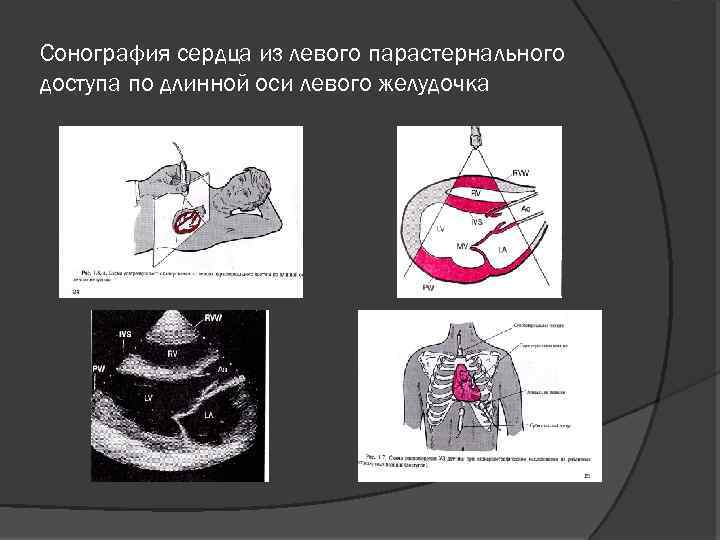 Парастернальная линия это