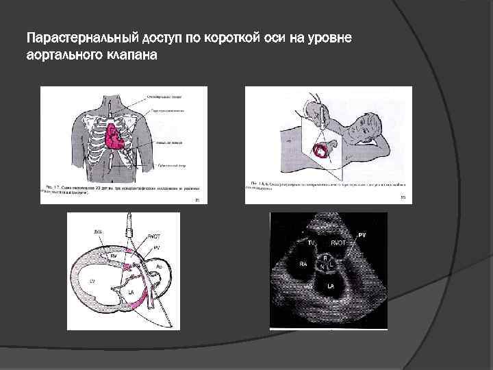 Парастернальная линия это