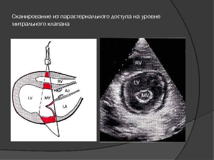 Парастернальная линия это