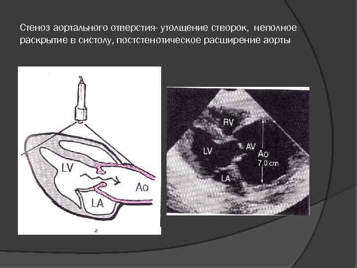 Утолщение створок аортального клапана