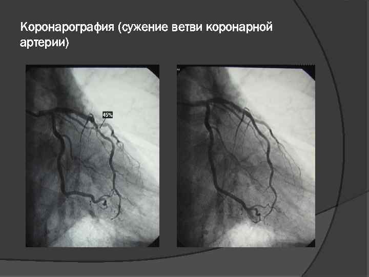 Коронарография отзывы