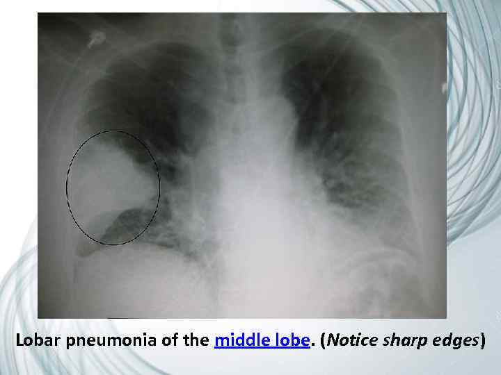 Lobar pneumonia of the middle lobe. (Notice sharp edges) 