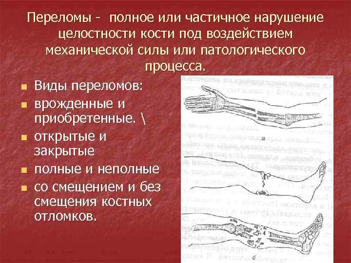 Переломы - полное или частичное нарушение целостности кости под воздействием механической силы или патологического