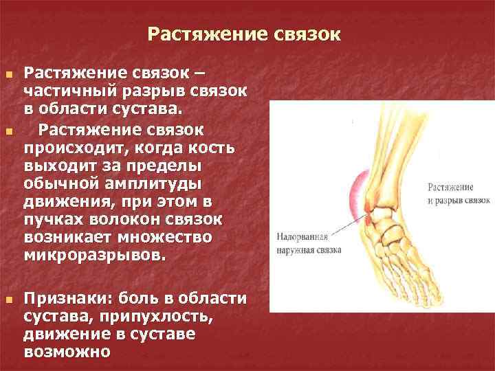 Растяжение связок n n n Растяжение связок – частичный разрыв связок в области сустава.