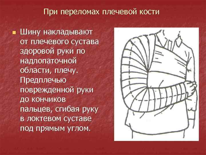 При переломах плечевой кости n Шину накладывают от плечевого сустава здоровой руки по надлопаточной