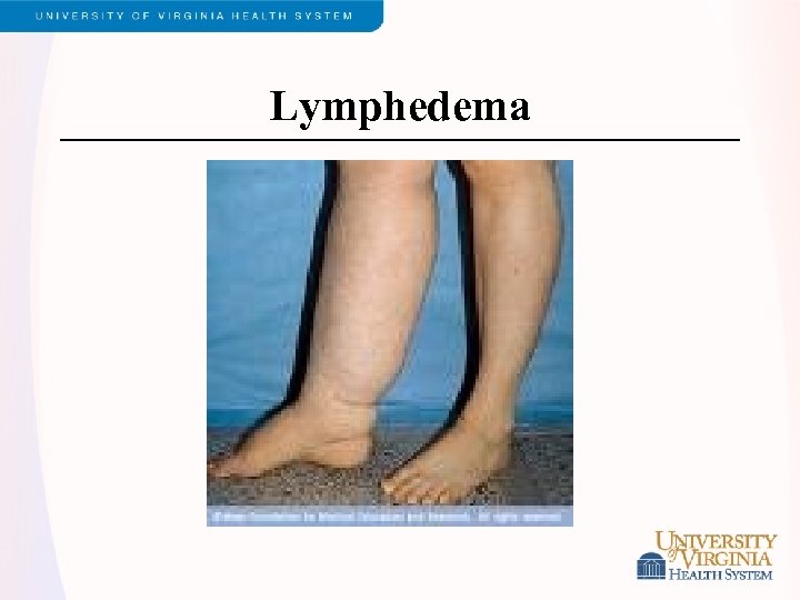 Lymphedema 
