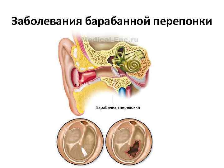 Заболевания барабанной перепонки 